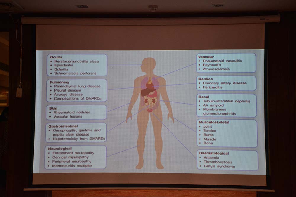 Understanding Rheumatoid Arthritis: Symptoms, Diagnosis, Treatment