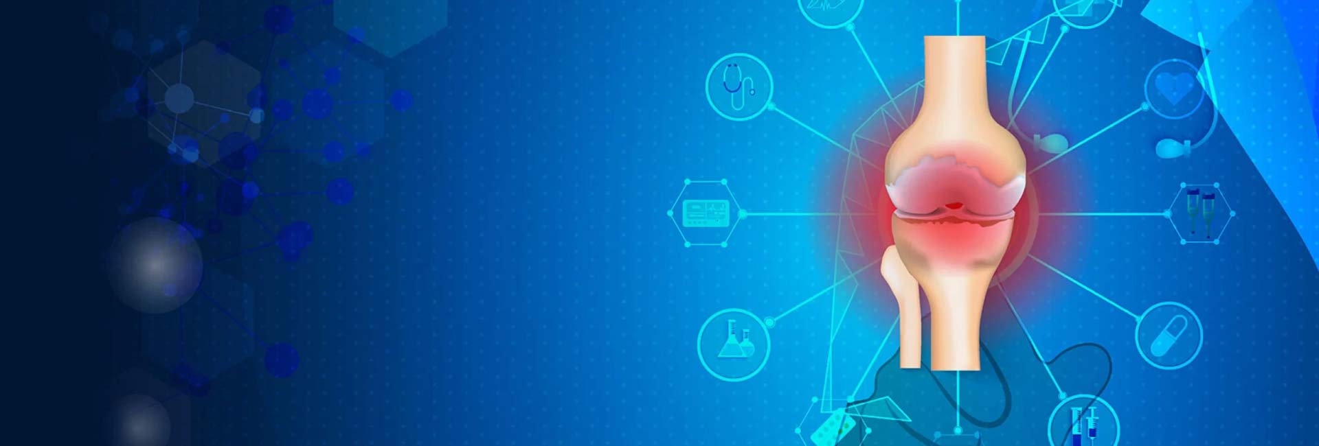 Causes of Rheumatoid Arthritis