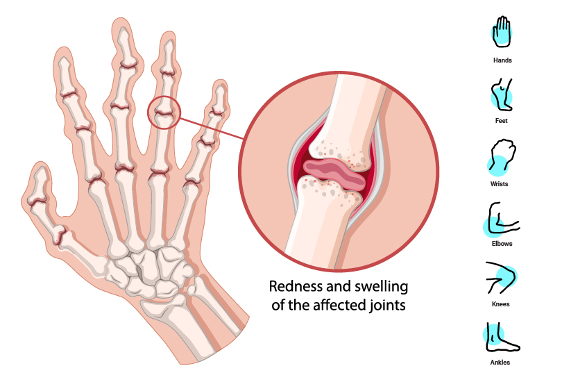 Understanding the Causes of Rheumatoid Arthritis