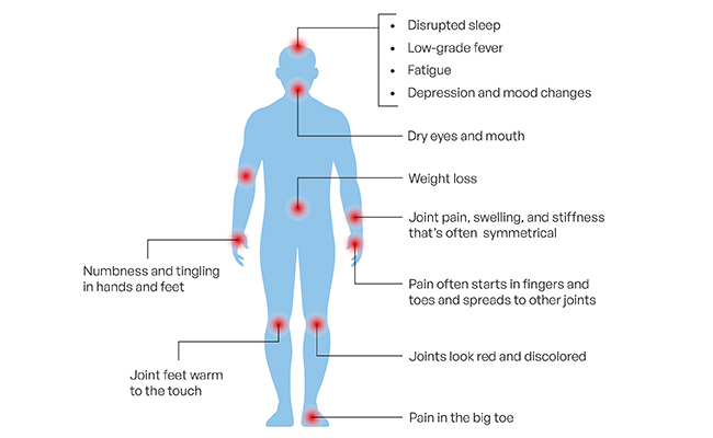 What is Rheumatoid Arthritis (RA)?