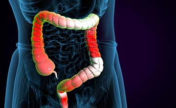 Management of Bowel Disease