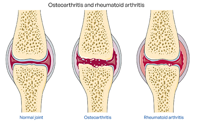 What Is Enteropathic Arthritis