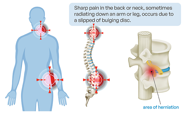 Possible Complications of Ankylosing Spondylitis