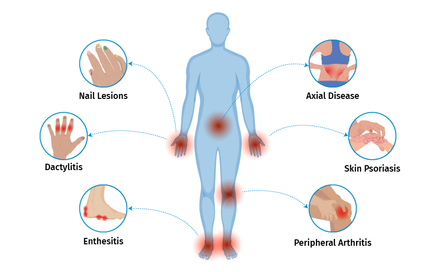 What is Psoriatic Arthritis