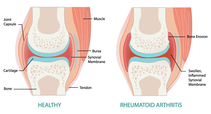 Overview of RA Treatment