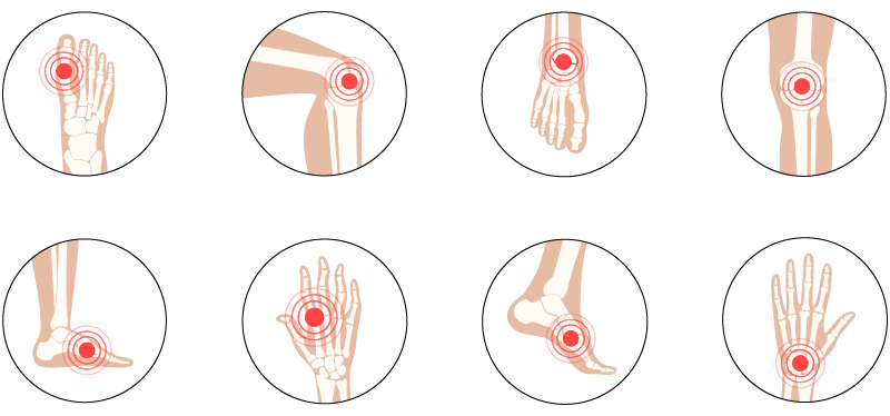 Rheumatoid Arthritis: An Overview of Its Forms