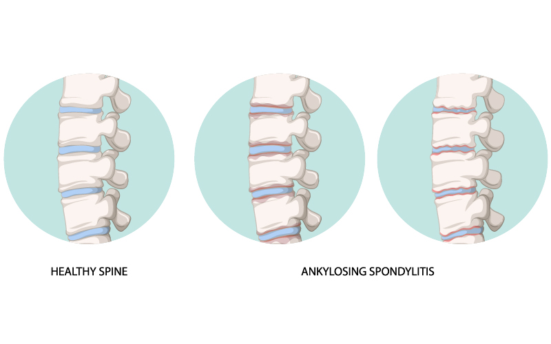 What is spondylitis