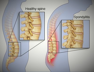 BackSpine