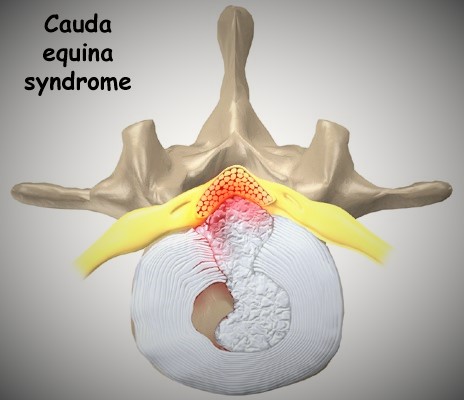 Cauda Equina Syndrome