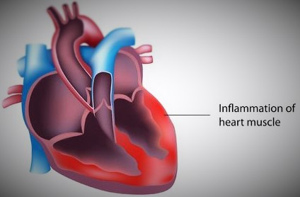 Heart Pain