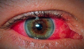 Uveitis