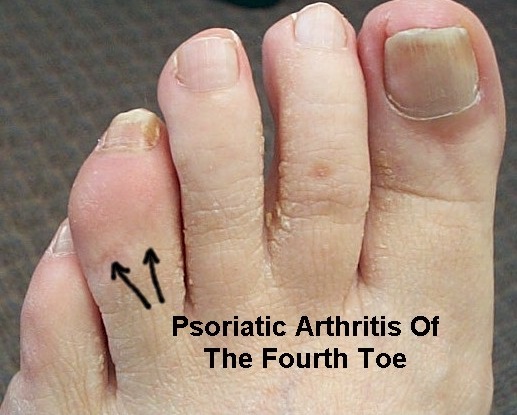 Psoriatic Arthritis Causes