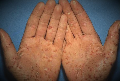 Reactive Arthritis