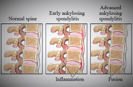 Symptoms of AS