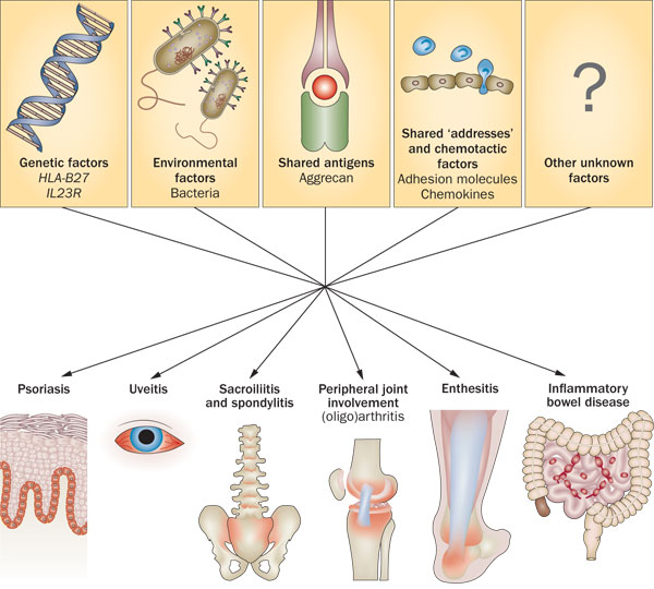 Symptoms of ankylosing spondylitis