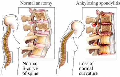 Ankylozujici Spondylitida