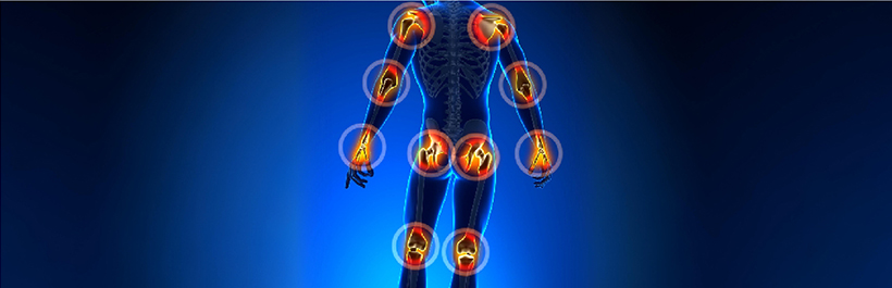 Myths About Ankylosing Spondylitis