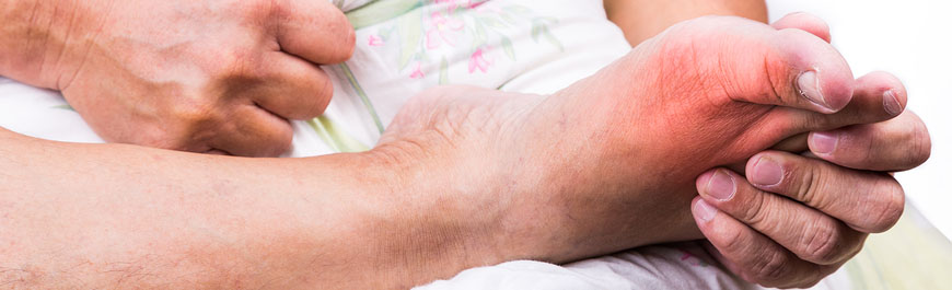 Uric acid and joint problem Gout