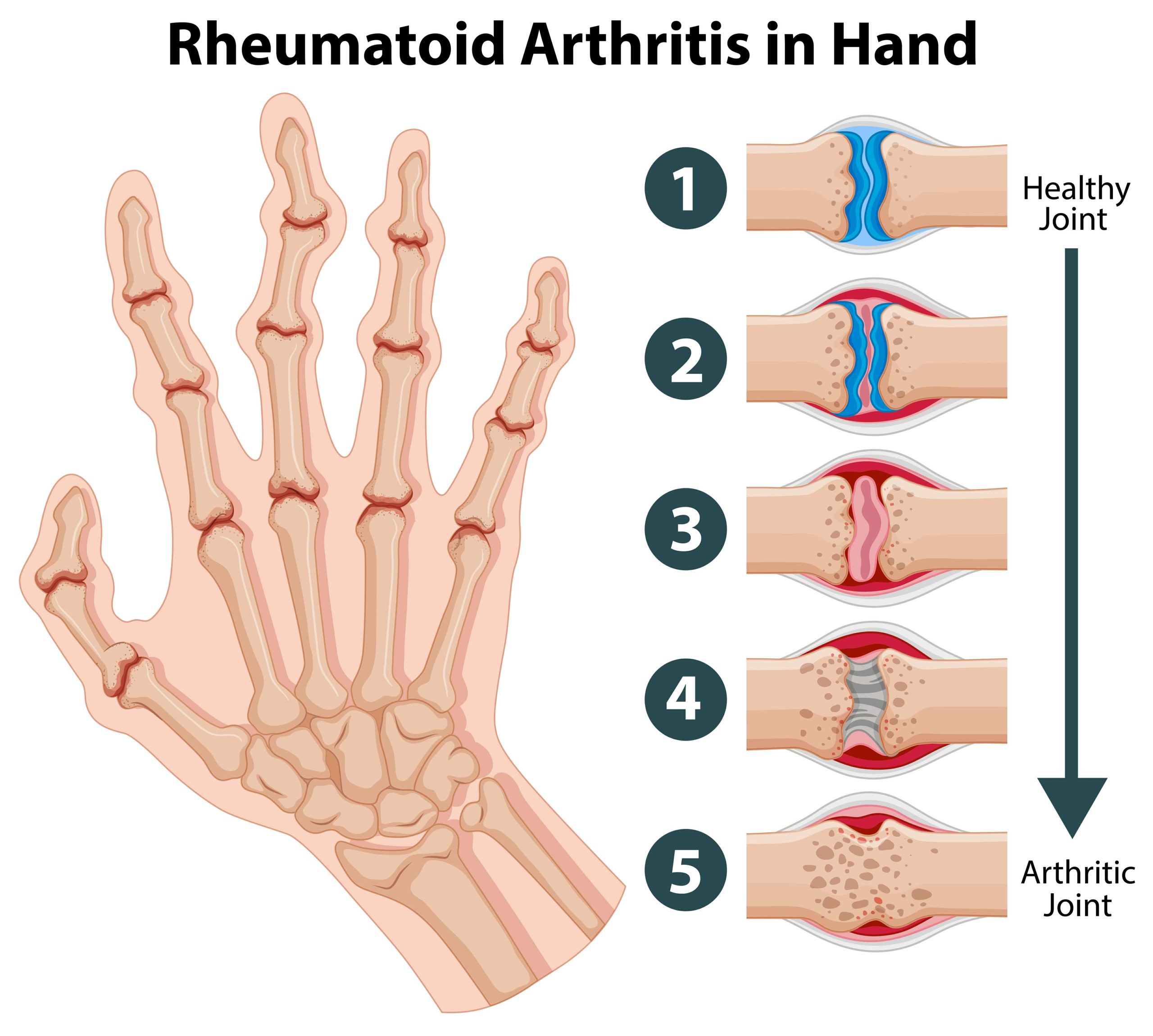 Complications of Untreated Rheumatoid Arthritis